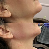 Jawline Before & After Gallery - Patient 54039829 - Image 1