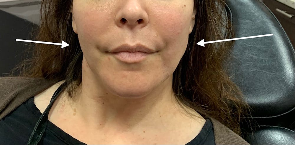 Jawline Before & After Gallery - Patient 54039829 - Image 2