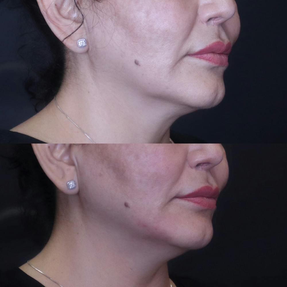Jawline Before & After Gallery - Patient 54039830 - Image 1