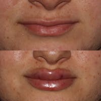 Lips Before & After Gallery - Patient 54039851 - Image 1