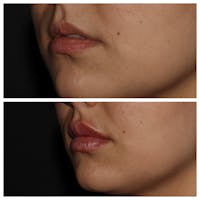 Lips Before & After Gallery - Patient 54039852 - Image 1