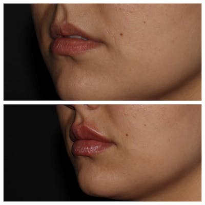 Lips Before & After Gallery - Patient 54039852 - Image 1