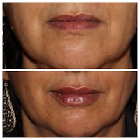 Lips Before & After Gallery - Patient 54039853 - Image 1