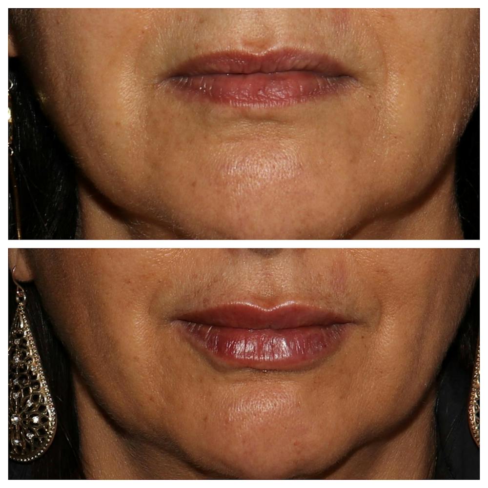 Lips Before & After Gallery - Patient 54039853 - Image 1