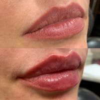 Lips Before & After Gallery - Patient 54039854 - Image 1