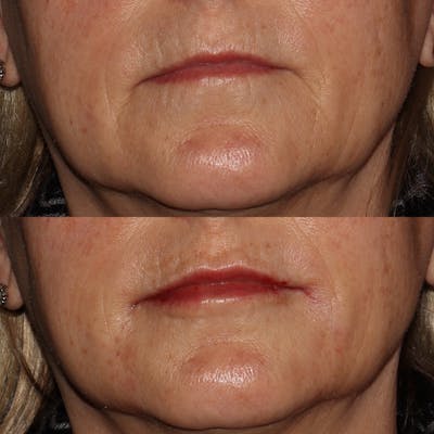Lips Before & After Gallery - Patient 54039855 - Image 1
