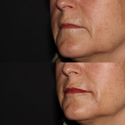 Lips Before & After Gallery - Patient 54039855 - Image 2