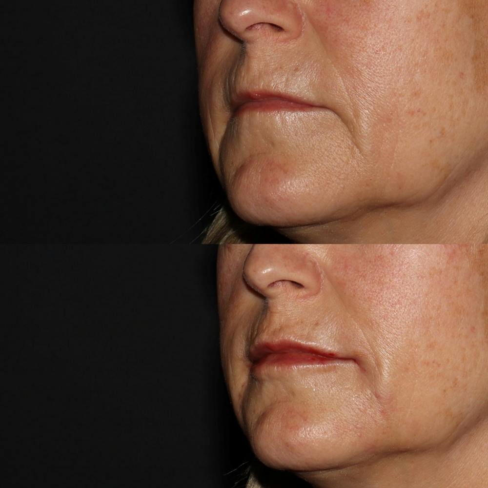 Lips Before & After Gallery - Patient 54039855 - Image 2