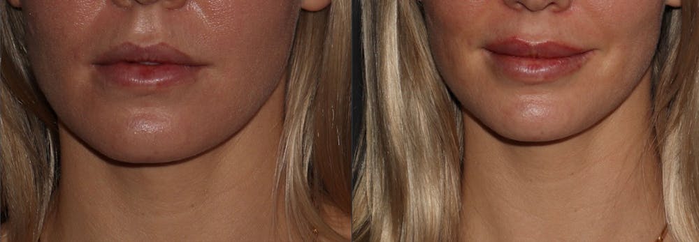 Lips Before & After Gallery - Patient 6096529 - Image 1