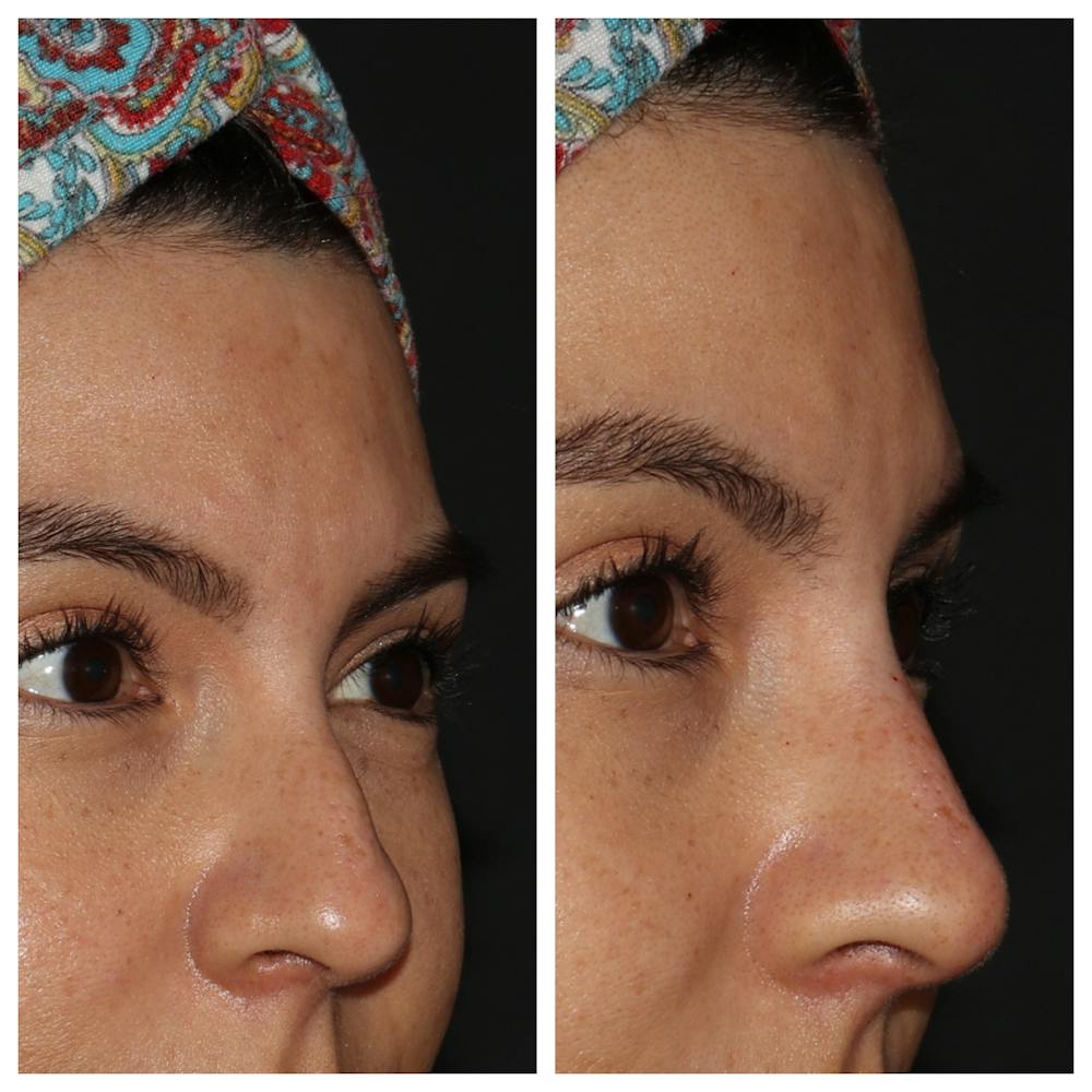 Nose Before & After Gallery - Patient 54039859 - Image 1