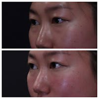 Eye Before & After Gallery - Patient 54039861 - Image 1