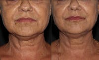 Morpheus 8 Laser Before & After Gallery - Patient 54039863 - Image 1