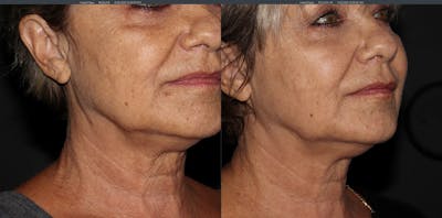 Morpheus 8 Laser Before & After Gallery - Patient 54039863 - Image 2