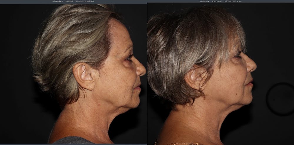 Morpheus 8 Laser Before & After Gallery - Patient 54039863 - Image 3