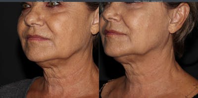 Morpheus 8 Laser Before & After Gallery - Patient 54039863 - Image 4