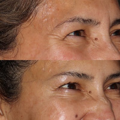 Botox Before & After Gallery - Patient 54039907 - Image 1