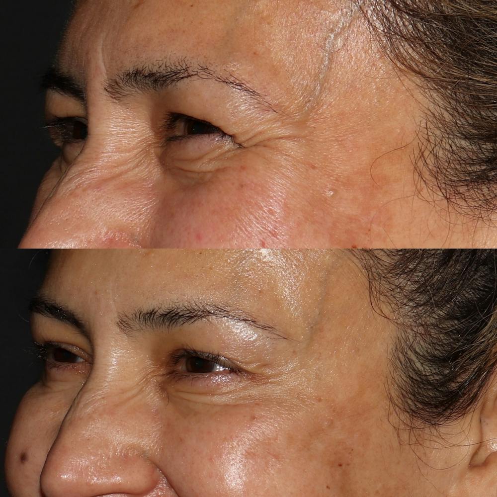 Botox Before & After Gallery - Patient 54039907 - Image 2