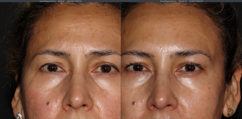 Botox Before & After Gallery - Patient 54039907 - Image 3