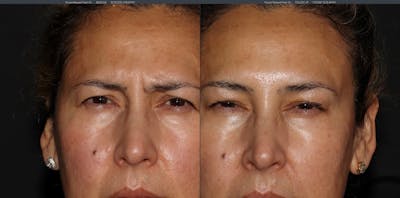 Botox Before & After Gallery - Patient 54039907 - Image 4