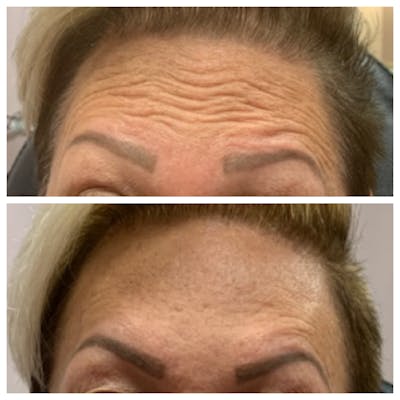 Botox Before & After Gallery - Patient 54039908 - Image 1
