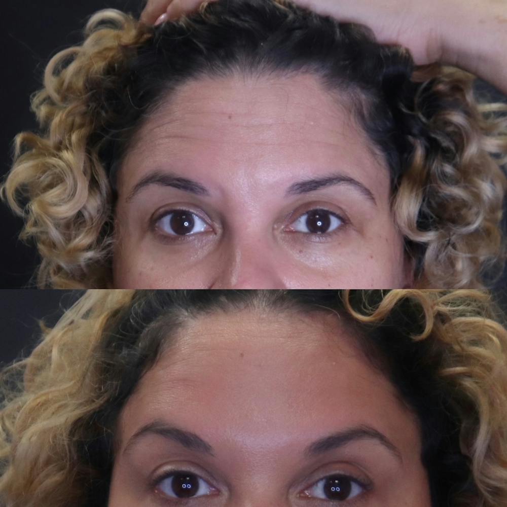 Botox Before & After Gallery - Patient 54039909 - Image 1
