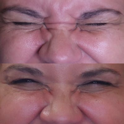 Botox Before & After Gallery - Patient 54039909 - Image 2