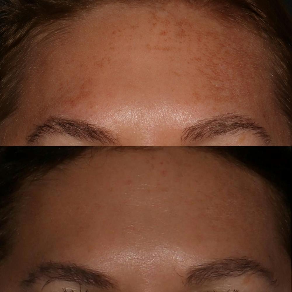 Chemical Peel Before & After Gallery - Patient 58143763 - Image 1