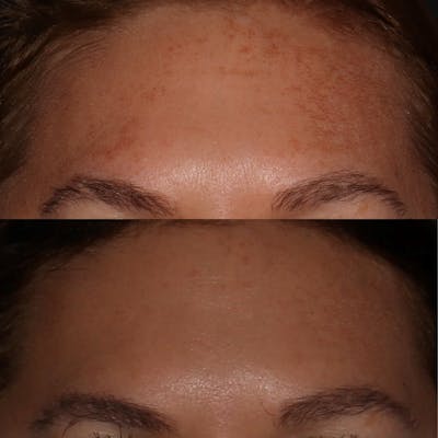 Chemical Peel Before & After Gallery - Patient 58143763 - Image 1