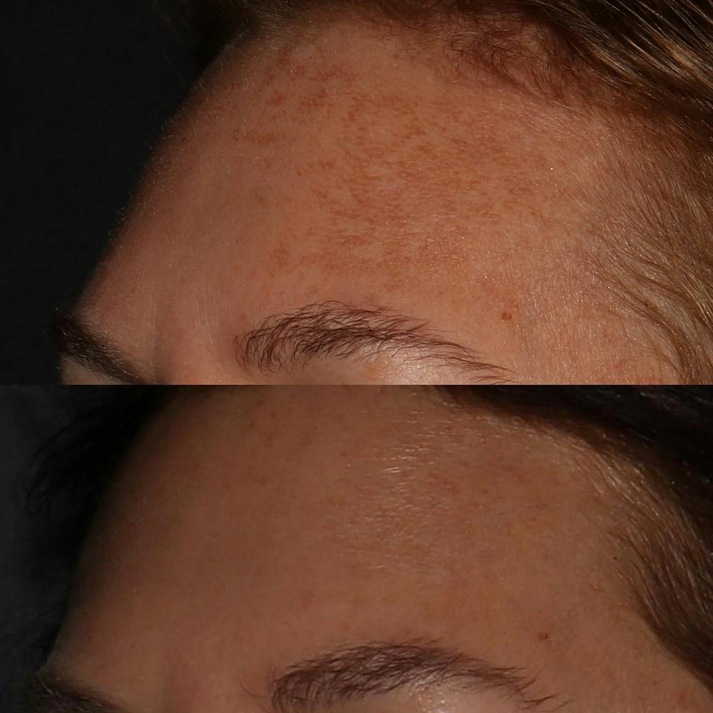 Chemical Peel Before & After Gallery - Patient 58143763 - Image 2