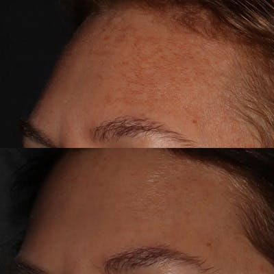 Chemical Peel Before & After Gallery - Patient 58143763 - Image 2
