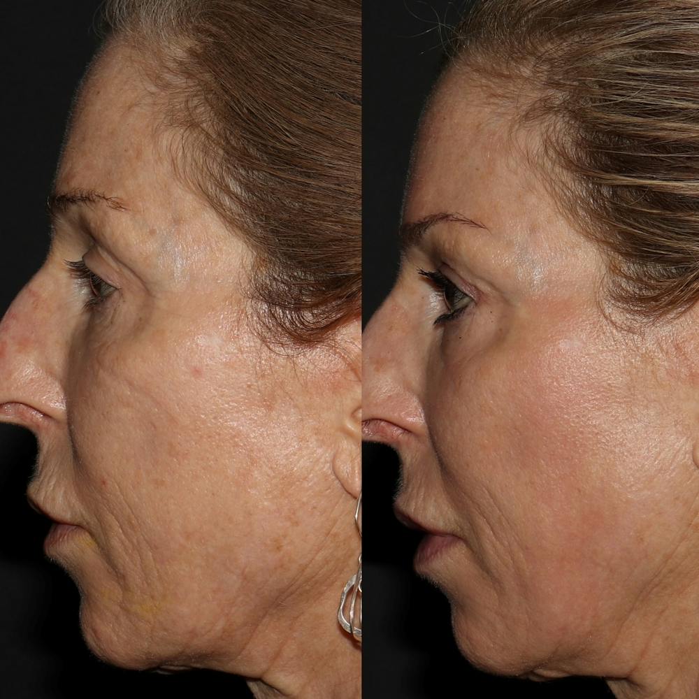 Chemical Peel Before & After Gallery - Patient 58143764 - Image 1