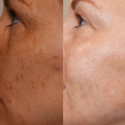CO2 Laser Before & After Gallery - Patient 58143771 - Image 1