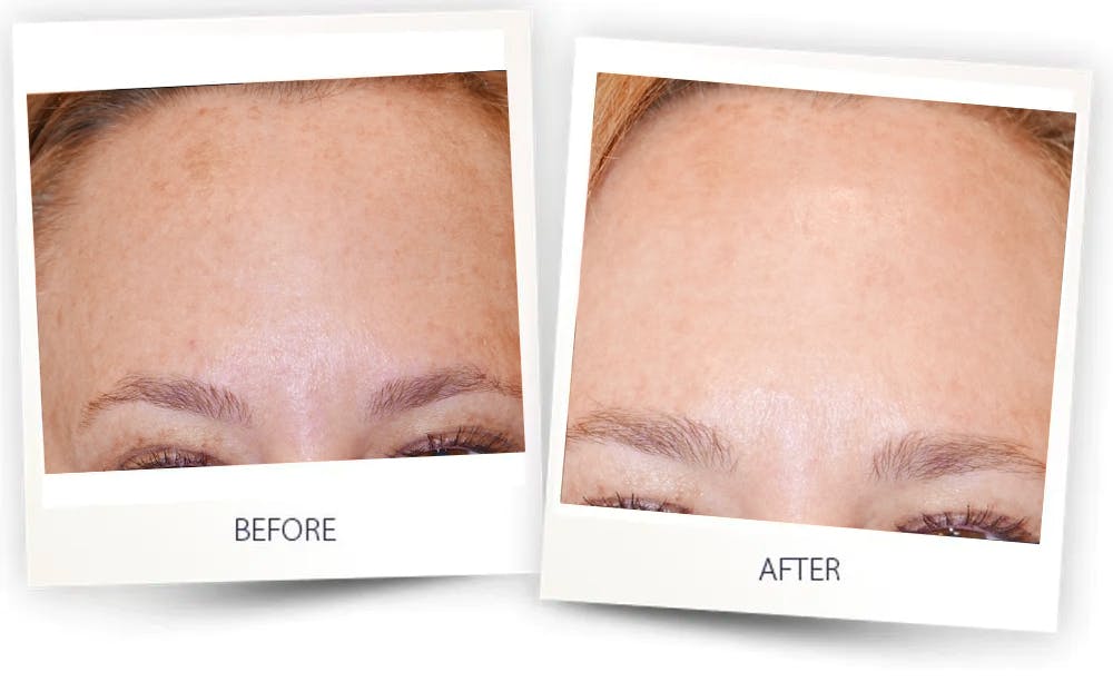 Erbium Pixel Laser Before & After Gallery - Patient 58143967 - Image 1