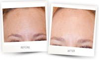 Erbium Pixel Laser Before & After Gallery - Patient 58143967 - Image 1