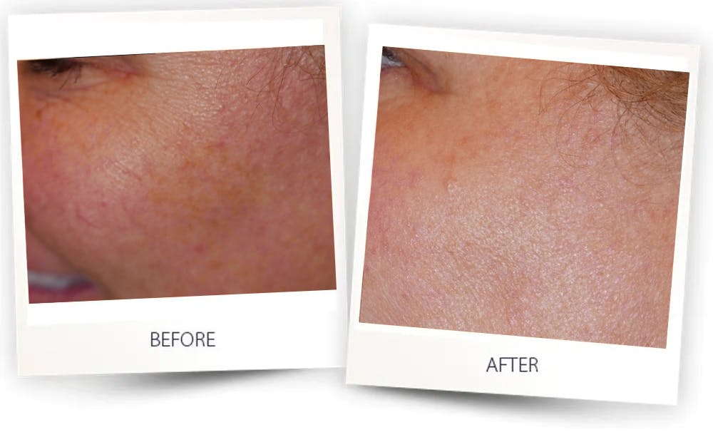 Erbium Pixel Laser Before & After Gallery - Patient 58143967 - Image 2