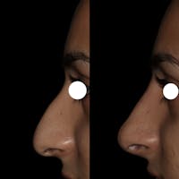 Nose Before & After Gallery - Patient 122343676 - Image 1