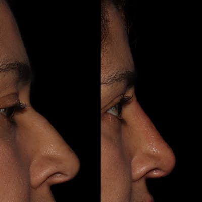 Nose Gallery - Patient 122343675 - Image 1