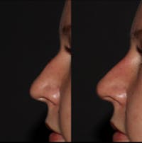 Nose Before & After Gallery - Patient 122343708 - Image 1