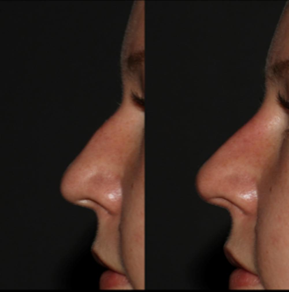 Nose Gallery - Patient 122343708 - Image 1