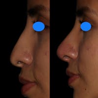 Nose Before & After Gallery - Patient 122343711 - Image 1