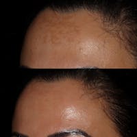 Cosemelan Peel Before & After Gallery - Patient 122343734 - Image 1