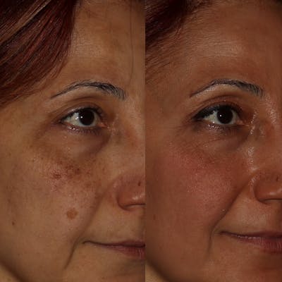 Cosemelan Peel Before & After Gallery - Patient 122343735 - Image 1