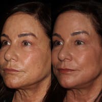 Cosemelan Peel Before & After Gallery - Patient 122343733 - Image 1