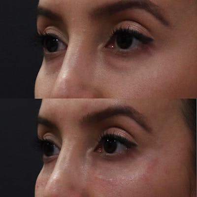 Eye Before & After Gallery - Patient 122343872 - Image 2