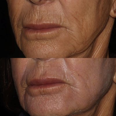 CO2 Laser Before & After Gallery - Patient 122343881 - Image 2
