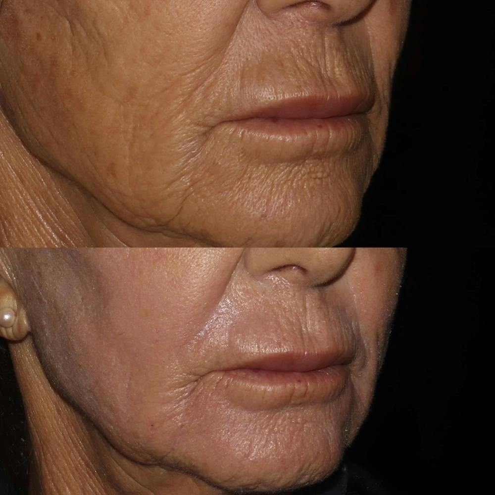 CO2 Laser Before & After Gallery - Patient 122343881 - Image 3