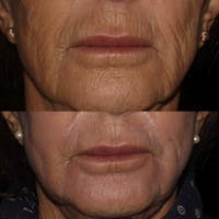 CO2 Laser Before & After Gallery - Patient 122343881 - Image 1
