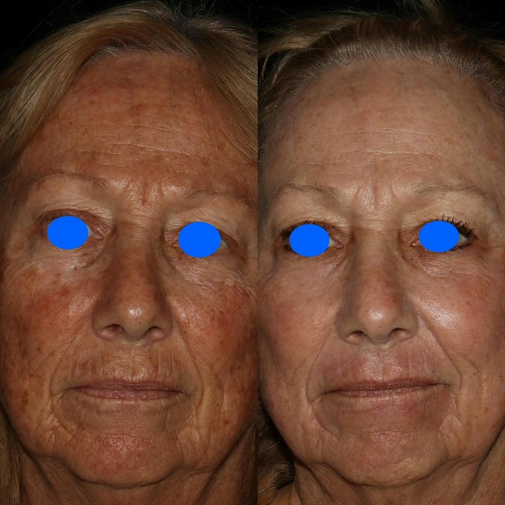 CO2 Laser Before & After Gallery - Patient 122362696 - Image 1