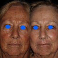 CO2 Laser Before & After Gallery - Patient 122362696 - Image 1