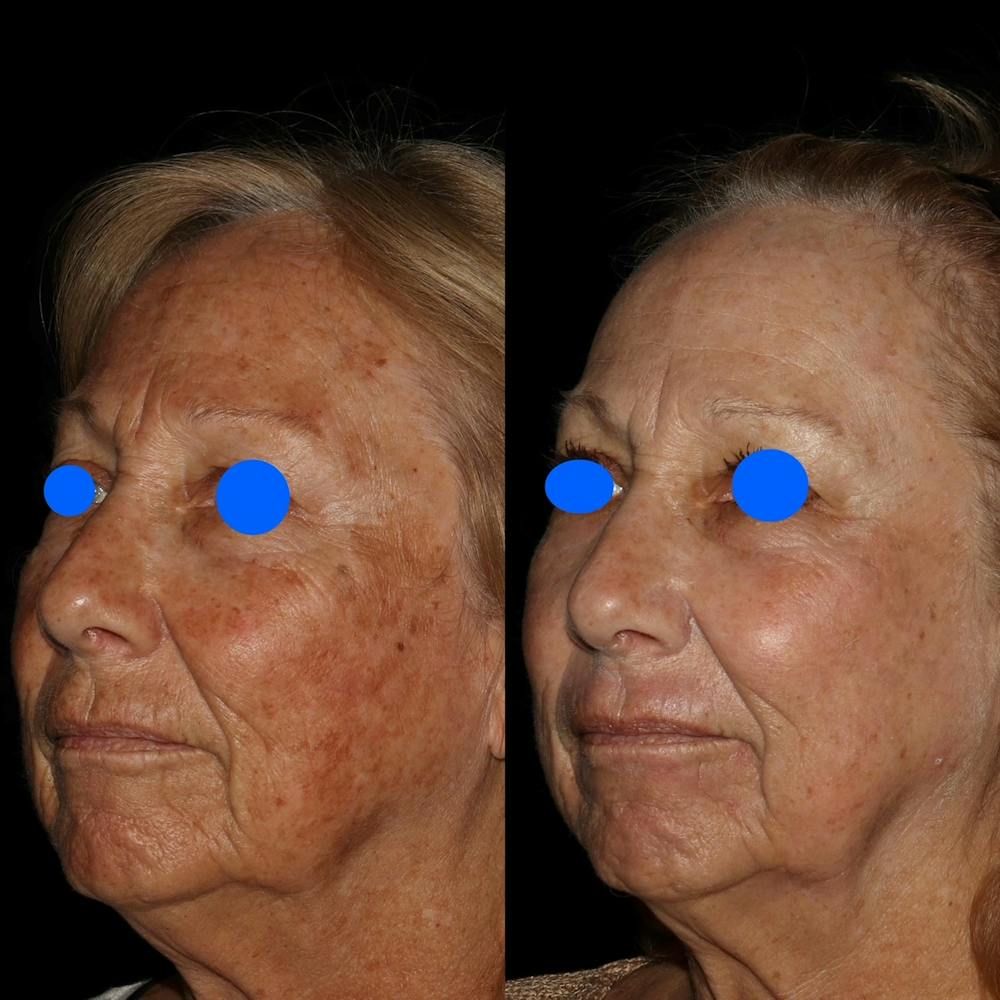 CO2 Laser Before & After Gallery - Patient 122362696 - Image 2